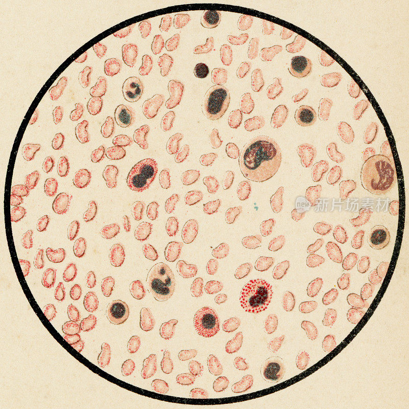急性淋巴细胞白血病患者血液细胞的显微镜观察- 19世纪